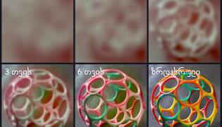 მხედველობის განვითარება ბავშვობაში